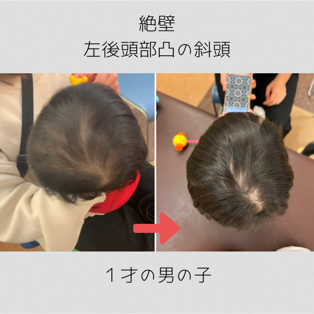 子供の頭のへこみは大丈夫？大泉門と危険なサインの見極め方