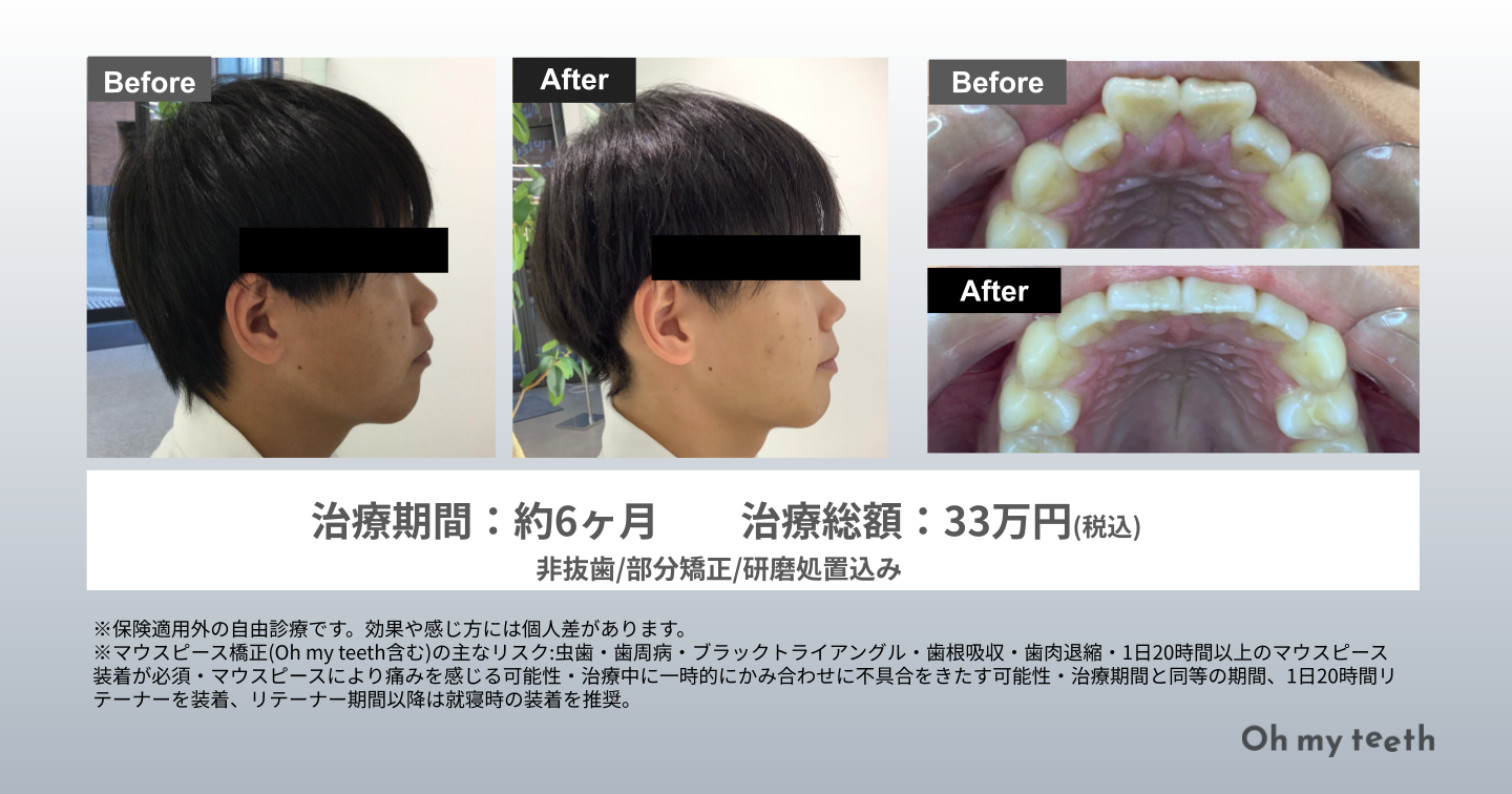 歯列矯正で顔は激変するのか？輪郭やEライン変化の真相と失敗回避策