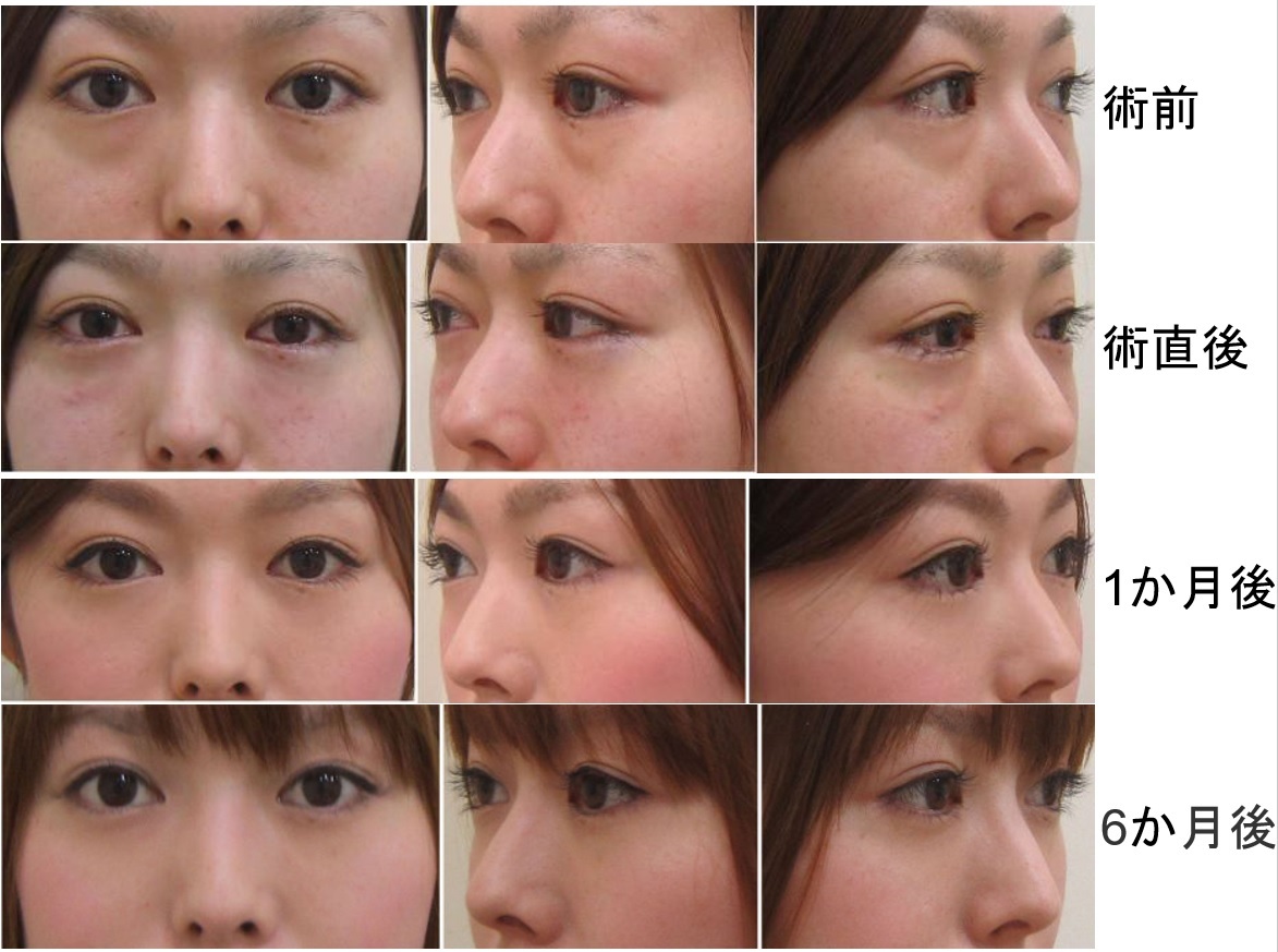 涙袋がない人は損？クール美人の真相と2026年最新垢抜け術
