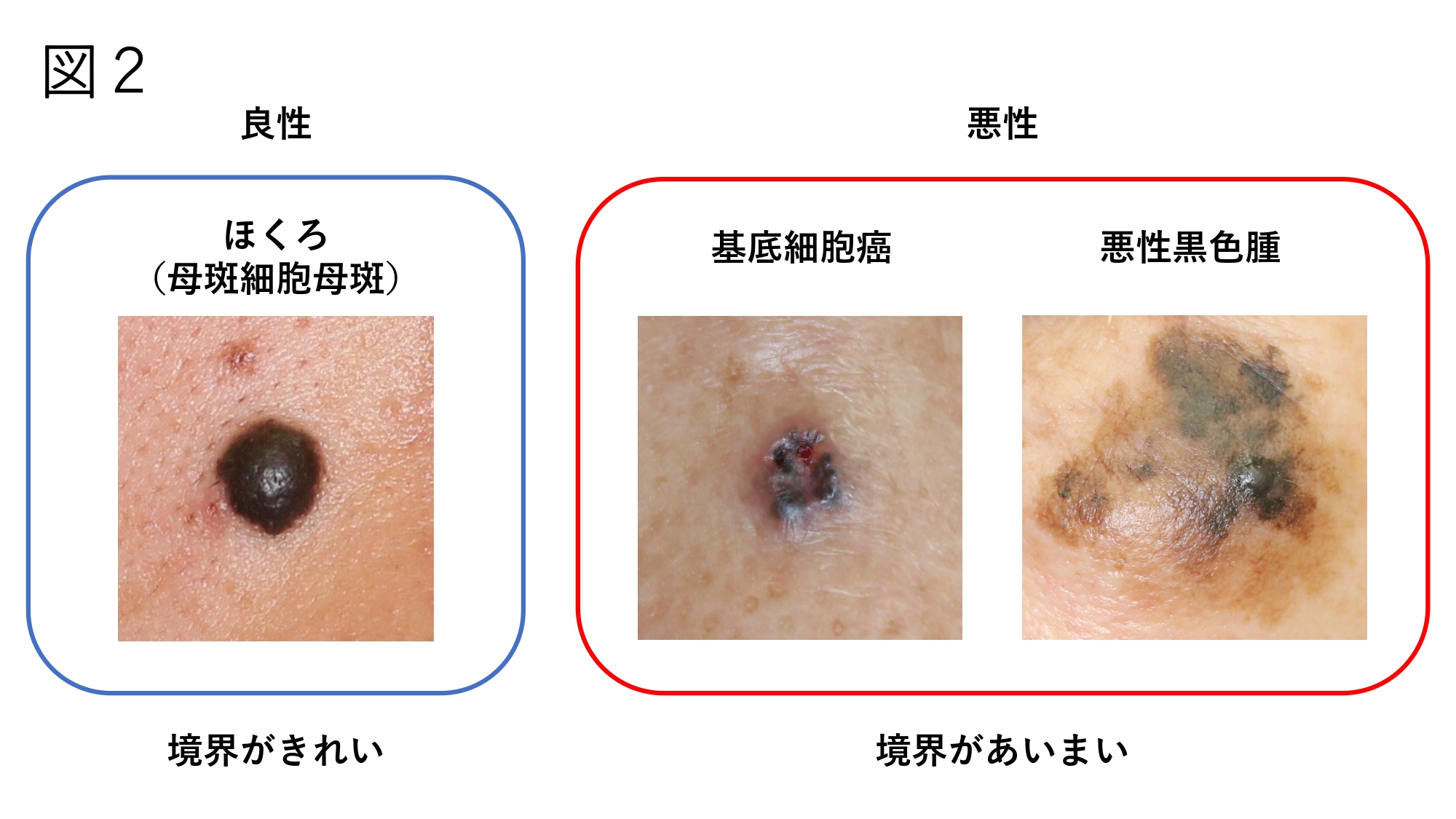 ほくろが多い人の意外な健康効果とは？メラノーマ予防と長寿の真実