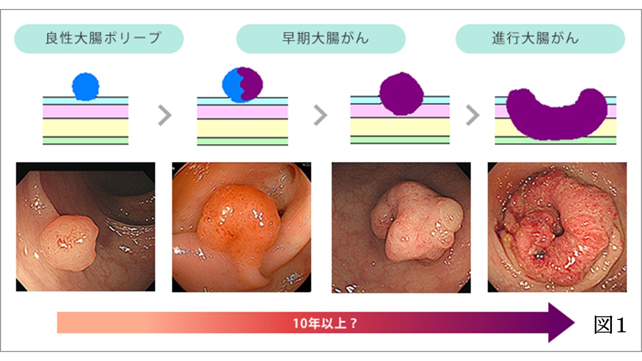 大腸ポリープ悪性画像の特徴とは？良性との見分け方とがん化率を検証