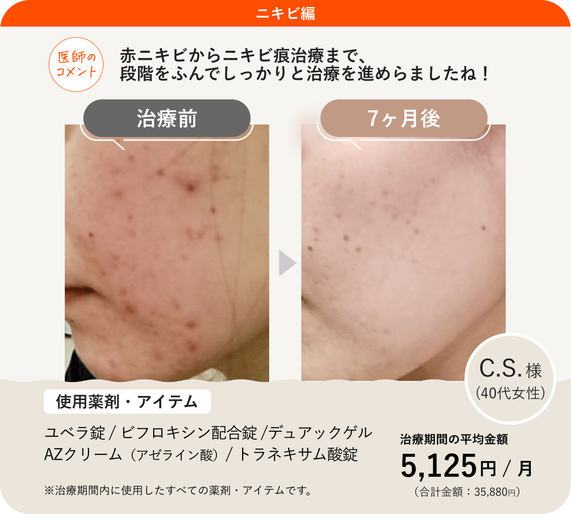 アゼライン酸の効果と副作用を徹底解説！ニキビ・赤ら顔改善の真相