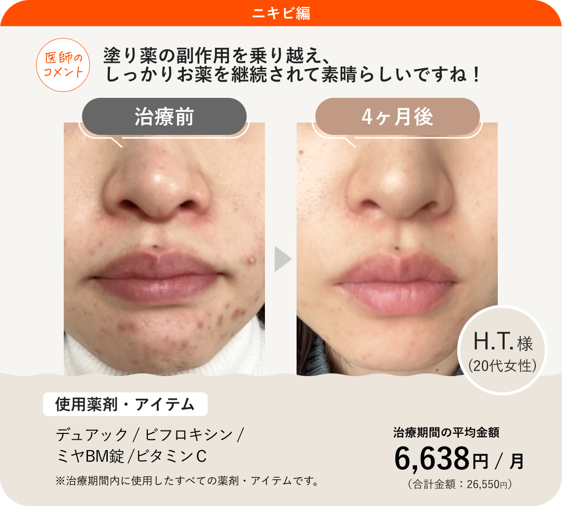 毎月繰り返す生理前ニキビの真相！皮膚科医が明かす劇的改善ルート