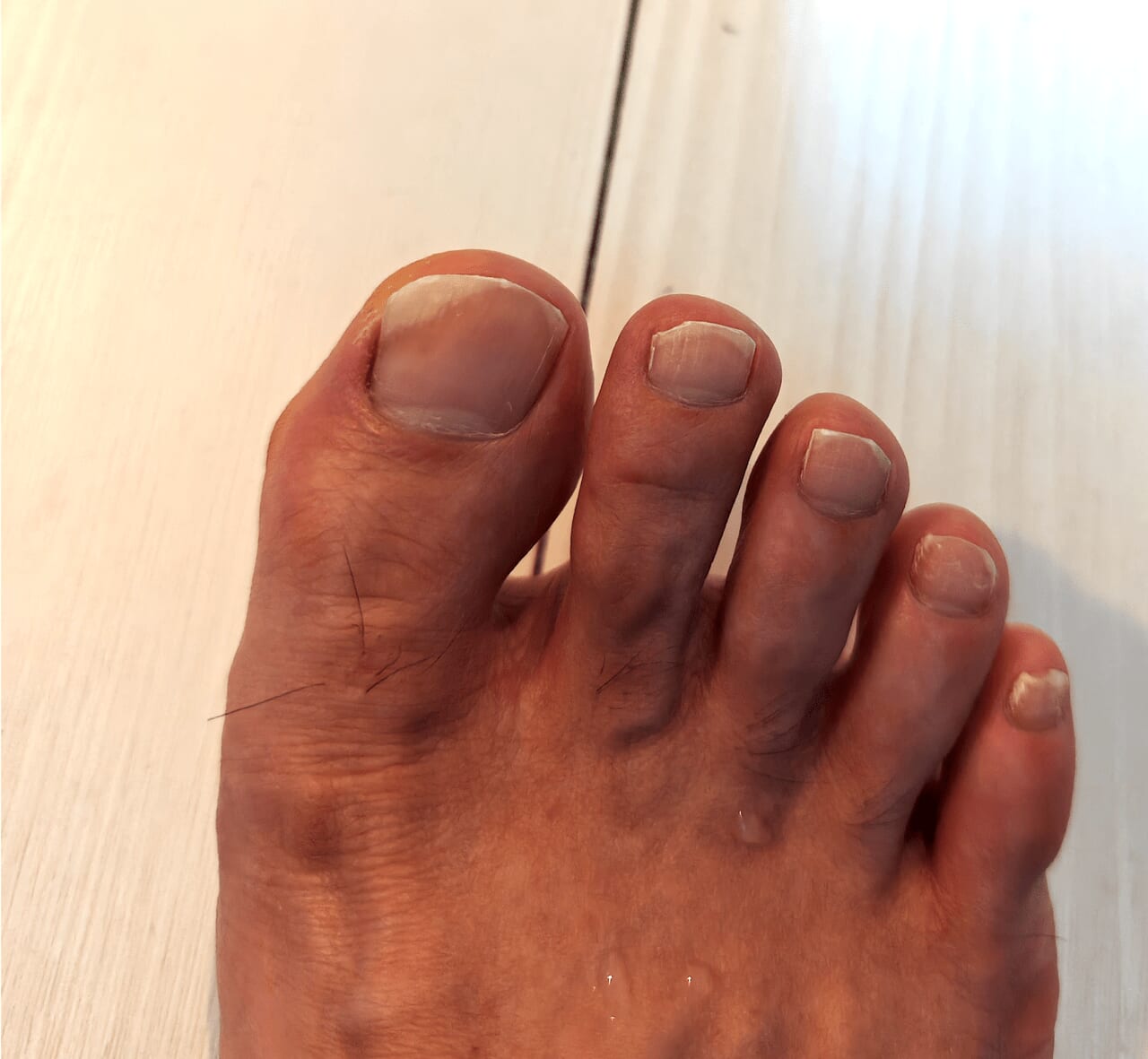 足の爪が剥がれる原因と病気の兆候！応急処置と生える期間の真相