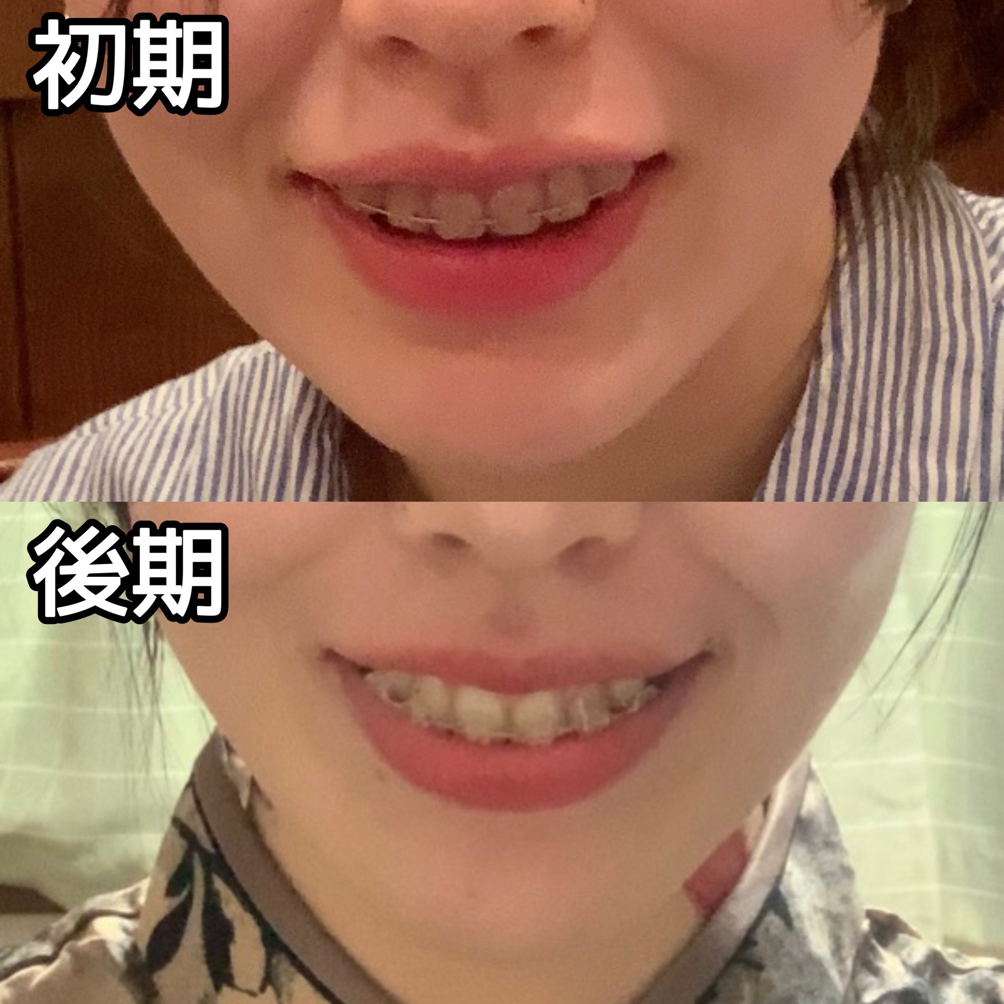 歯列矯正で老け顔に？症例写真が暴く頬こけ・ほうれい線の真相