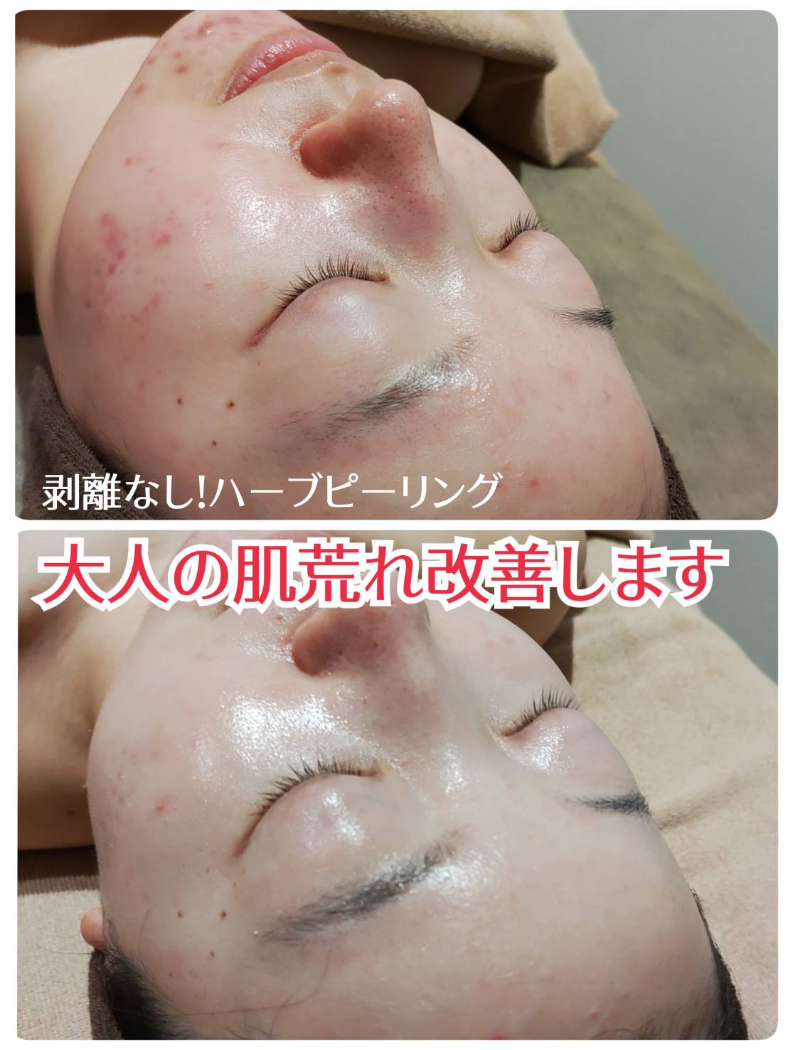 剥離なしハーブピーリング効果の真実｜皮が剥けないのに美肌になる理由