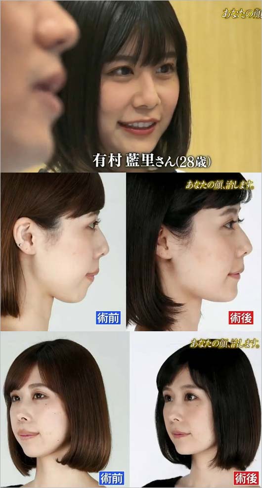 コンプレックスの克服か、美の過剰消費か？有村藍里が告白した「骨切り手術」から月日が流れた今、日本社会が向き合う容姿問題の現在地