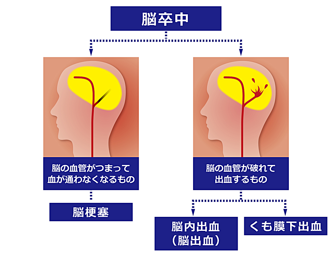 脳卒中と脳梗塞の違いを解説！前兆サインと救急対応の基準【2026】