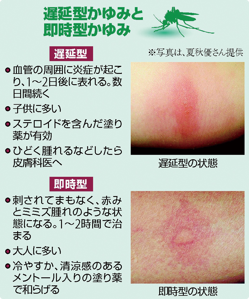 蚊に刺されて激しい腫れや発熱？蚊アレルギーの正体と正しい対処法