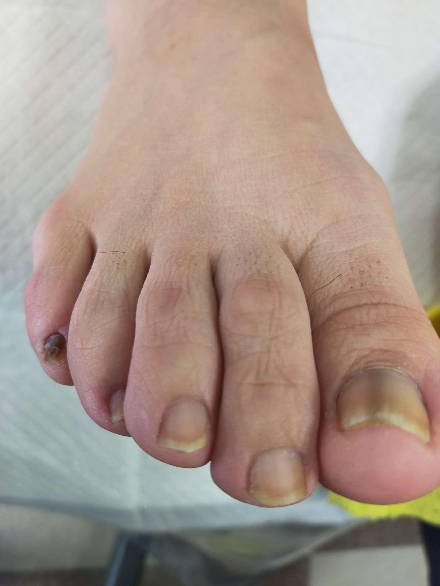 足の爪の縦線は老化だけじゃない？黒い線の危険サインと原因・治し方