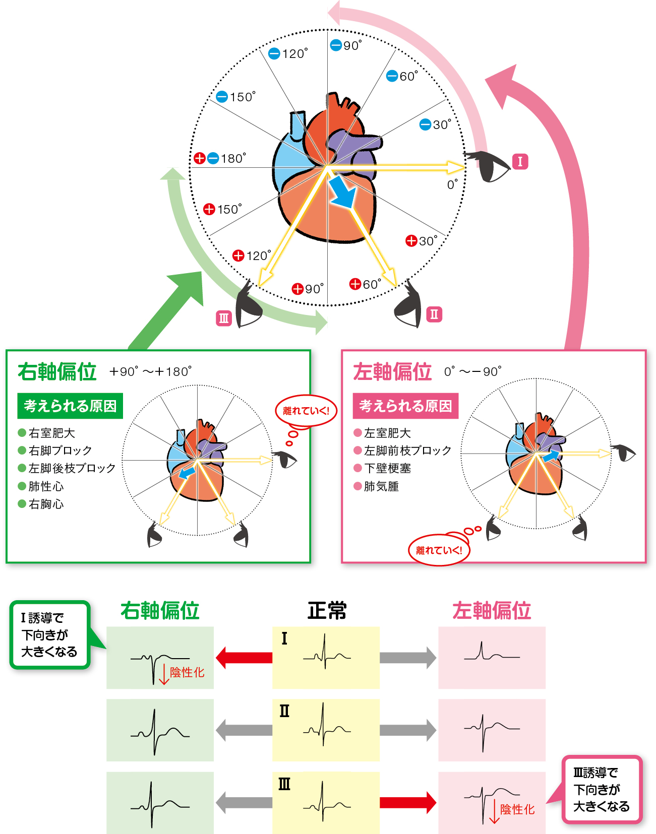 【2026年最新】心電図の左軸偏位は放置危険？原因と再検査基準