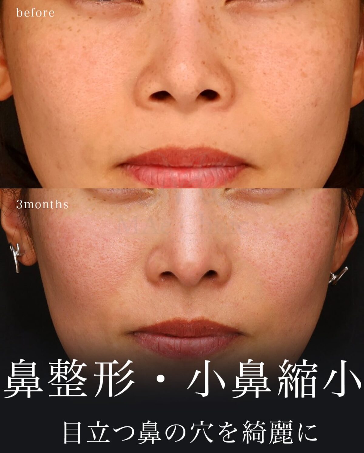正面から鼻の穴が見える原因と治し方｜自力改善の真相と2026年最新治療
