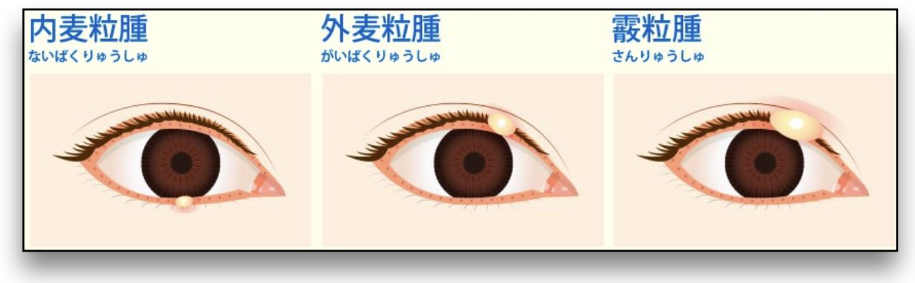 目の粘膜のできものはなぜ生じる？白い水ぶくれやしこりの正体と対処法