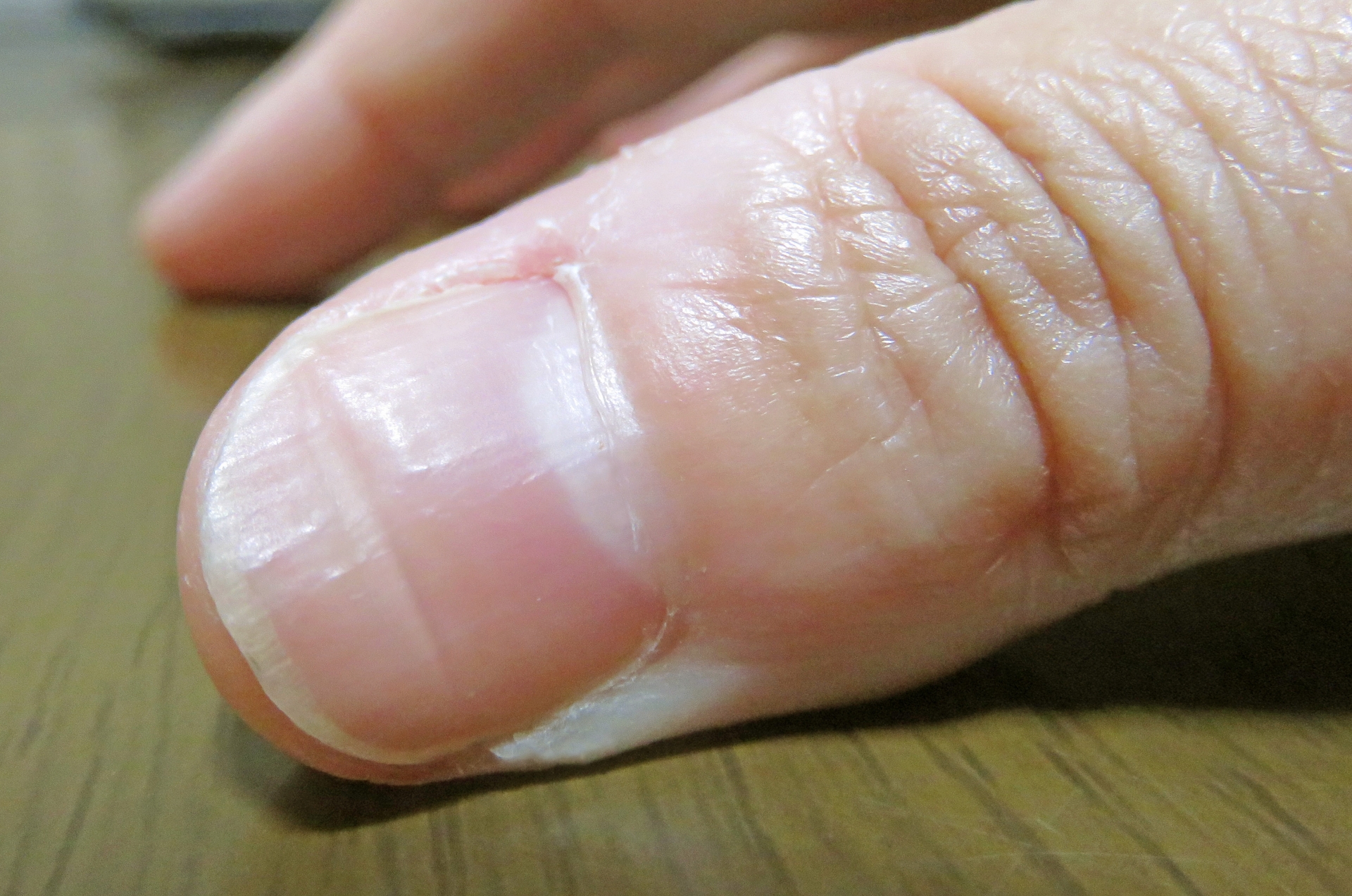 爪に横線が入る原因とは？病気や栄養不足のサインと治し方を徹底解説