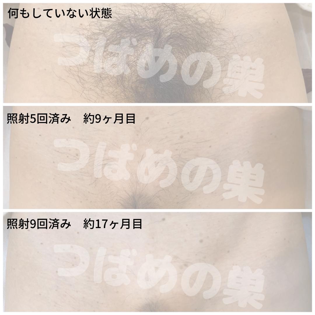 女性Vio脱毛の経過写真と症例で見る毛量変化・人気の形と後悔の真相