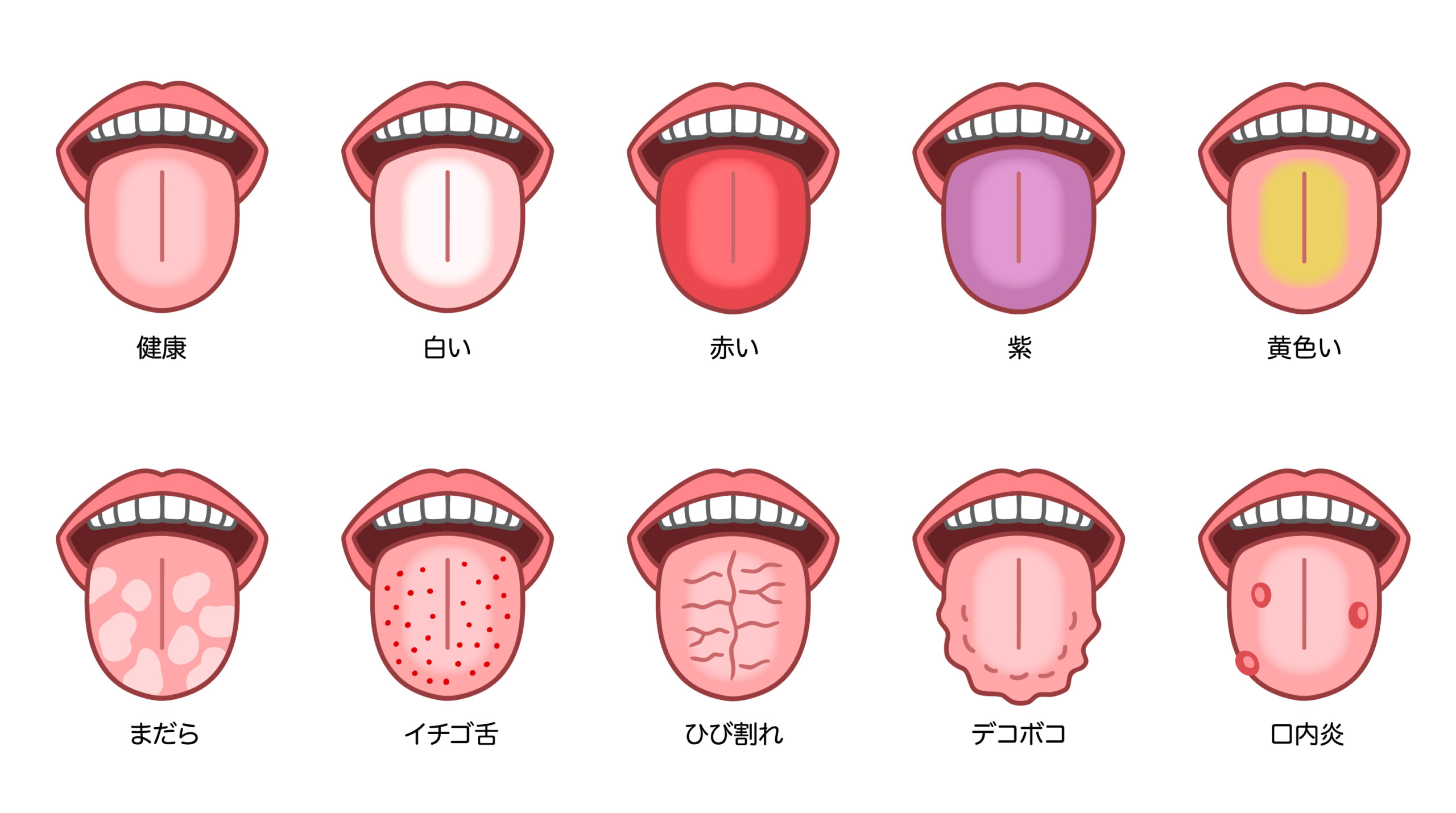 毎朝の舌チェックで病気を見抜く！危険なSosサインと受診目安