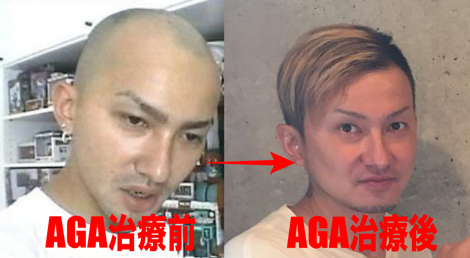 Da Pump・Issaのハゲ疑惑と髪復活の真相！植毛の噂を徹底検証
