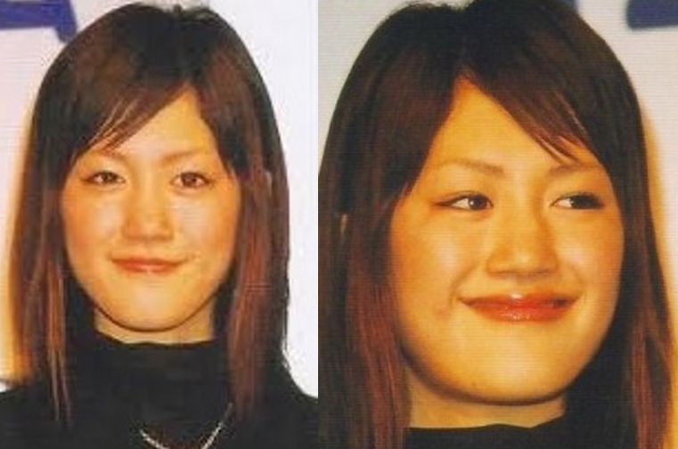 【2026年最新】顎変形症の手術を決断した芸能人たち｜激変したビジュアルの裏にあった苦悩と公的保険医療のリアル