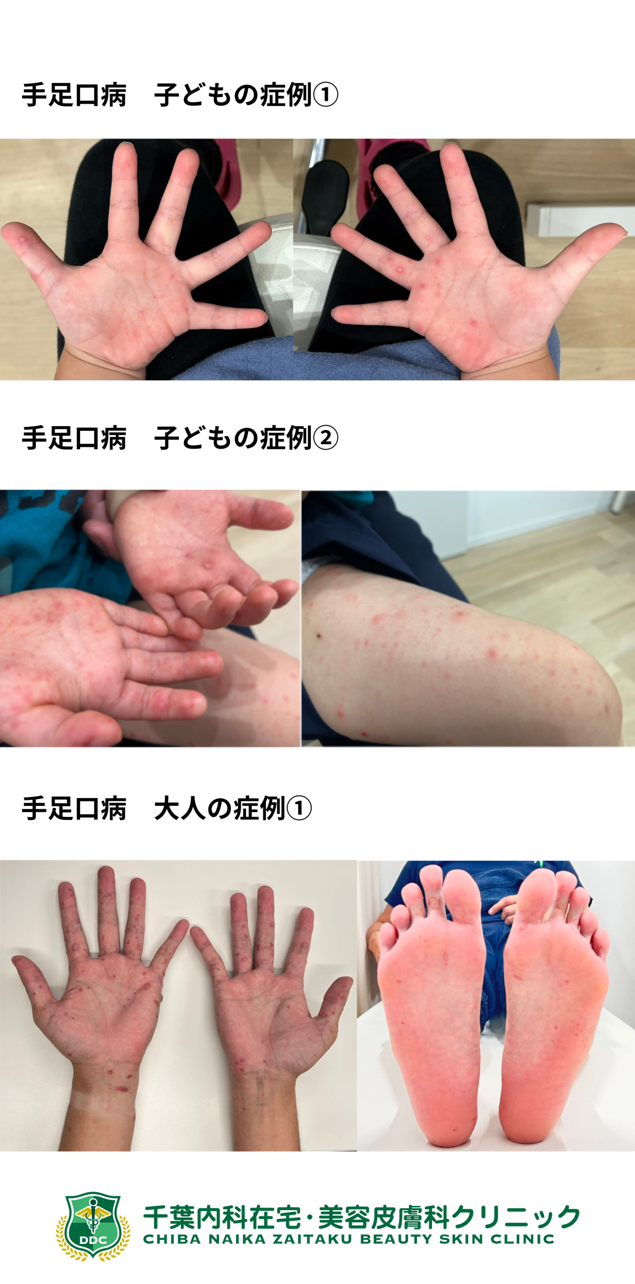 手足口病に大人がうつる確率は？知恵袋の壮絶体験と重症化の真実
