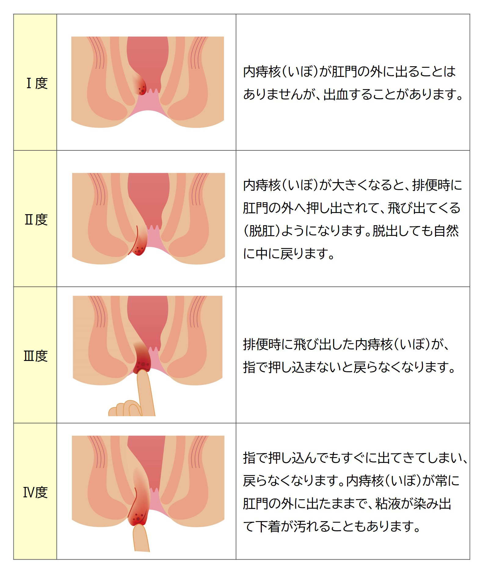 いぼ痔は自宅で治せる？自力での治し方と市販薬の選び方