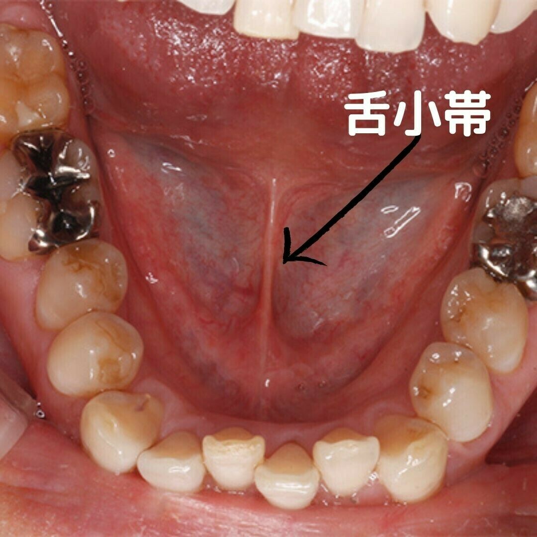 舌小帯短縮症の手術は失敗する？再癒着や後悔の真相と最新判断基準
