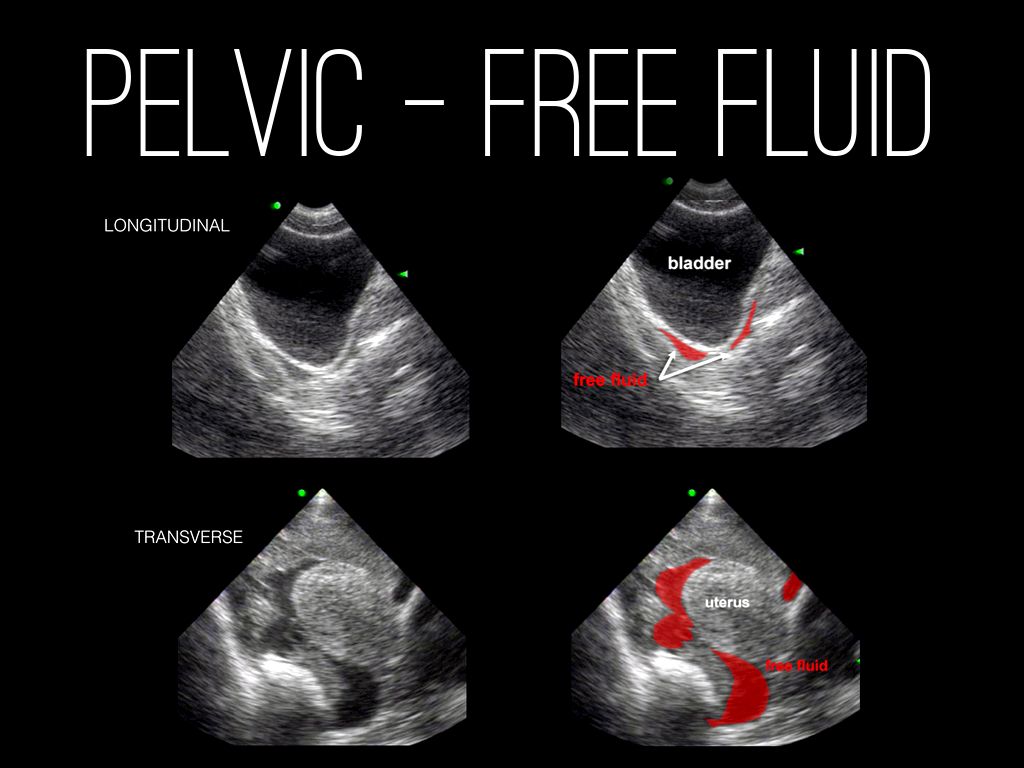 Causes of Free Fluid in Pelvis in Females