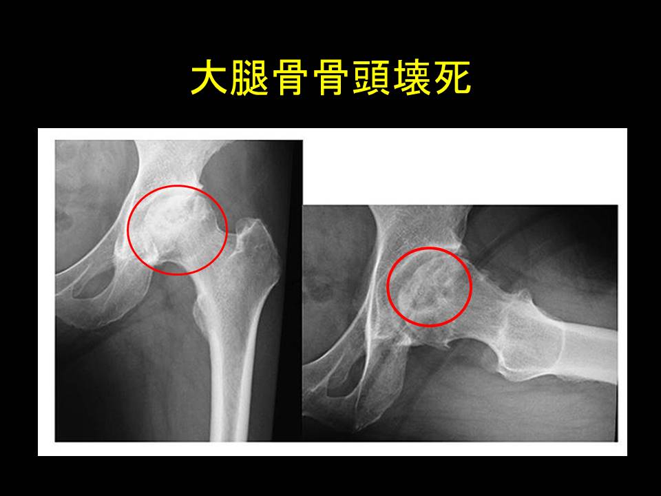 大腿骨頭壊死症を公表した芸能人の現在｜坂口憲二や千原ジュニアの闘病と復帰