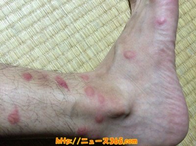 【必見】 ノミ に 刺され た 跡 ファン必見の最新情報 #647