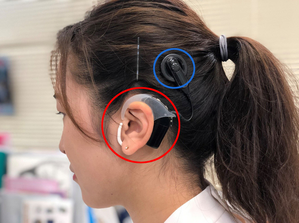 人工内耳で音を取り戻した有名人の真実！絶望から輝く復活のドラマ