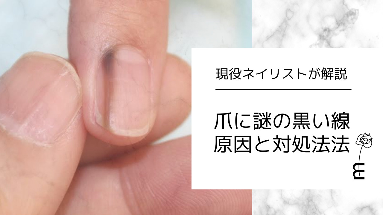 爪の黒い線は放置Ng？メラノーマとほくろの見分け方【2026年最新】