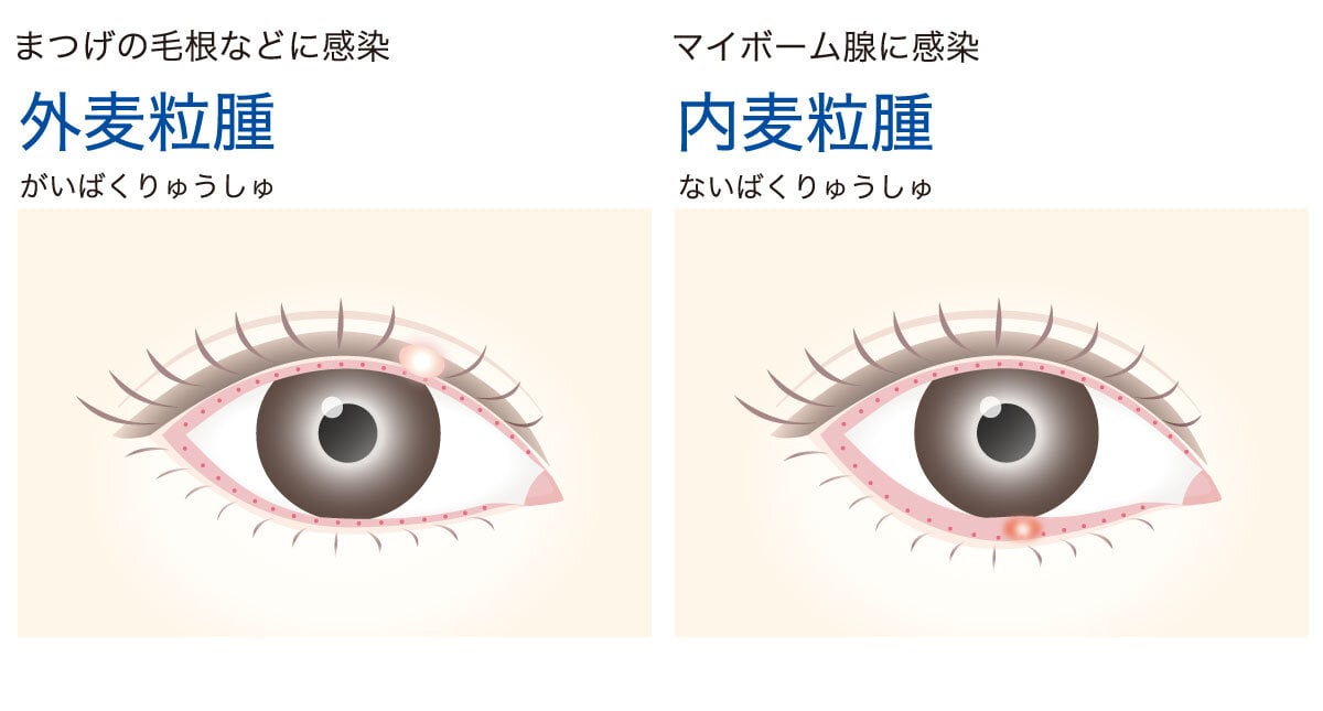 まぶたの脂肪取りは自力で可能？噂のマッサージ効果と危険なNg行動の真実