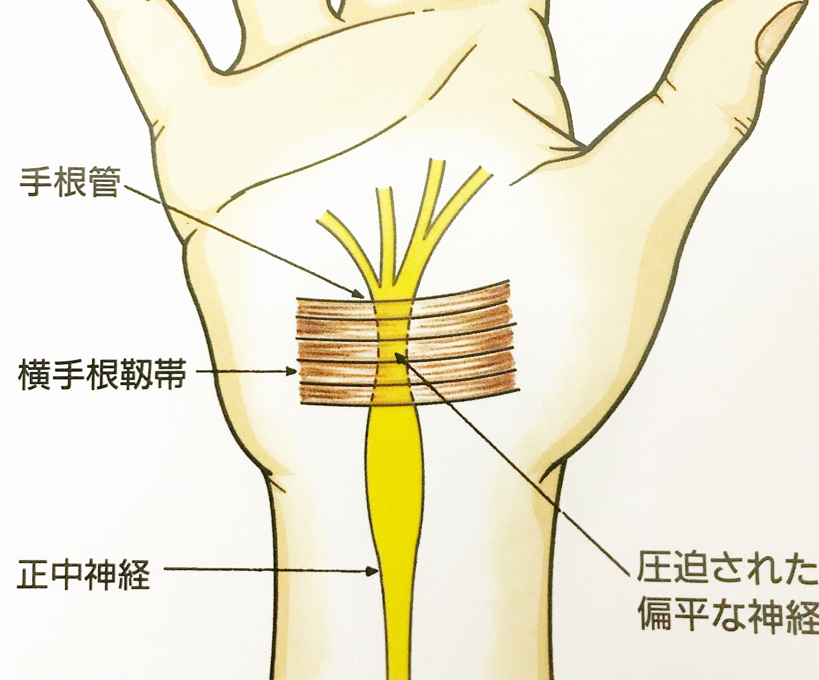 手根管症候群は自分で治せる？しびれ解消ストレッチと悪化防ぐNg行動