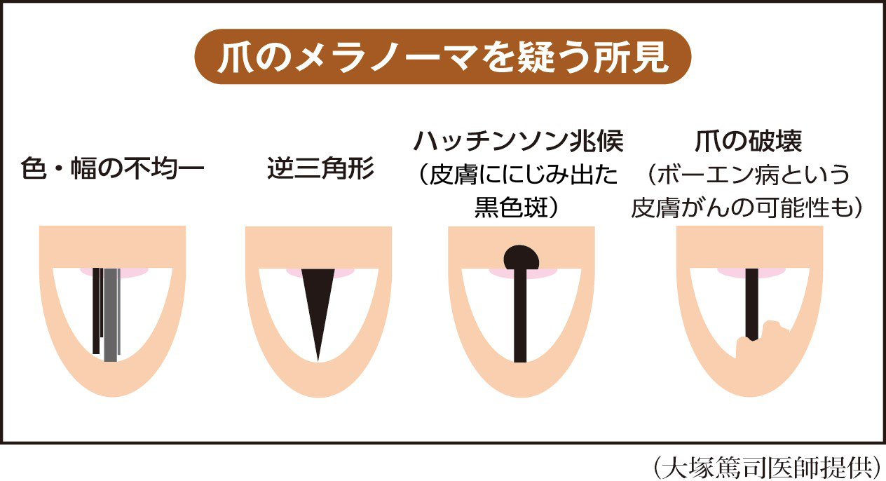 爪の黒い線はメラノーマ？単なるほくろとの見分け方と危険サイン
