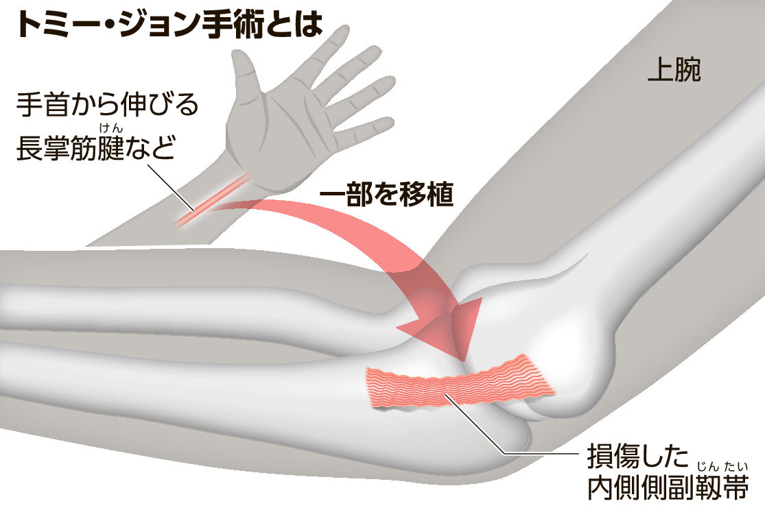トミージョン手術の真実｜大谷翔平の軌跡と球速アップの嘘・復帰期間