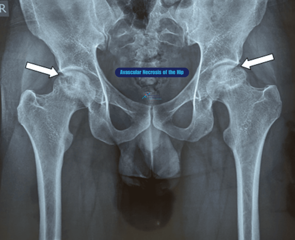 Avn of Left Hip Icd 10