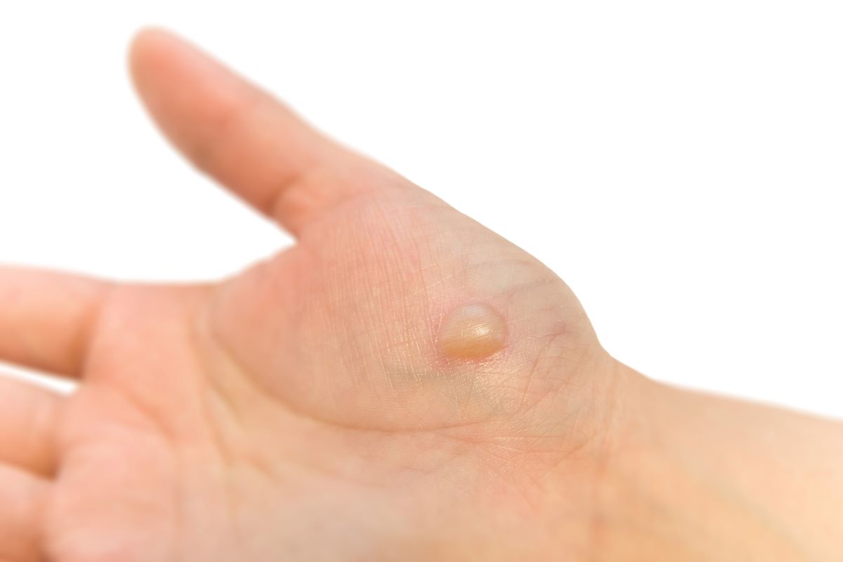 水ぶくれは潰すな！早くきれいに治す応急処置と跡を残さない新常識