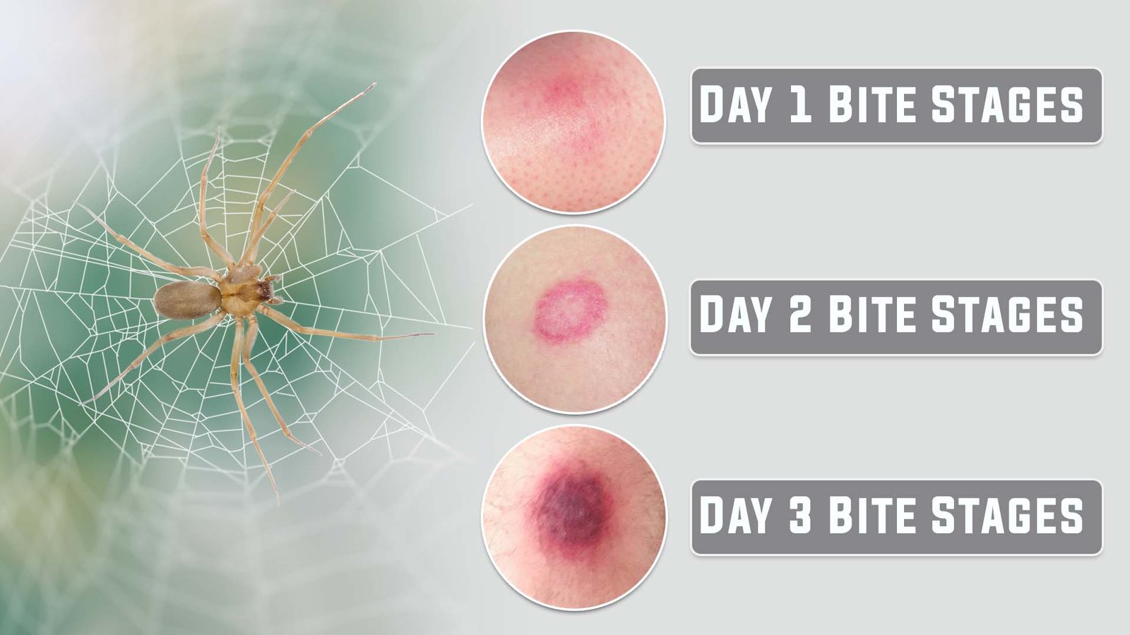 What Do You Do If You Have a Spider Bite