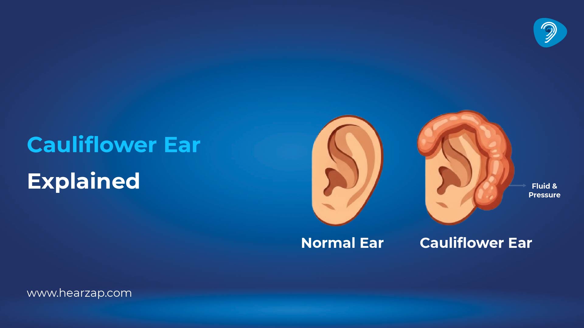 Why Do People Get Cauliflower Ear