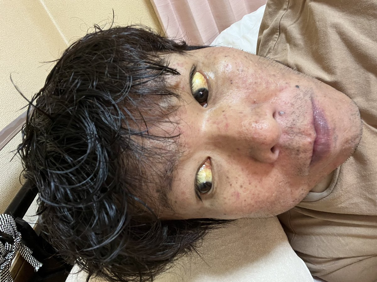 金バエの肌色激変にネット騒然！黄色や黒ずむ原因と肝硬変の真相