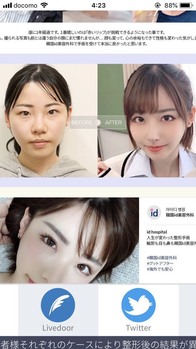 深田えいみの整形ビフォーアフター！昔の写真と公言した総額費用の真相