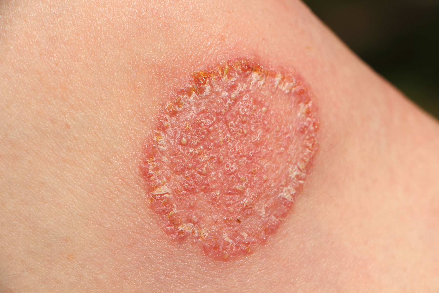 Fungal Skin Infections Pictures