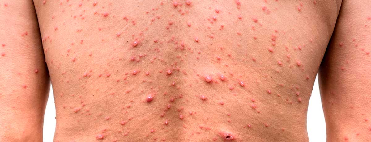Aids Patient Skin