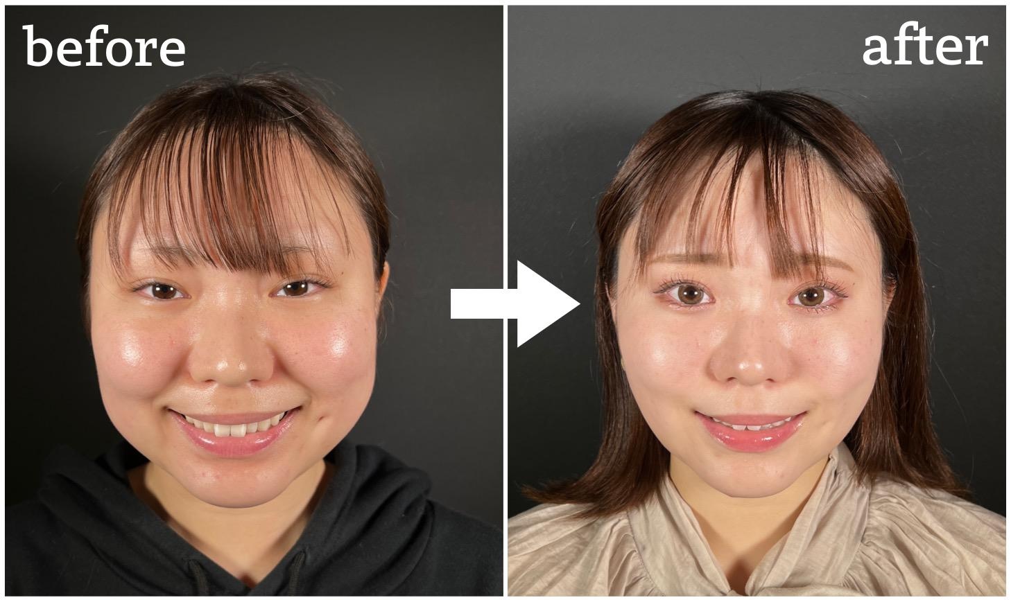 笑うと頬が盛り上がる原因とは？アンパンマン顔の治し方と小顔改善法