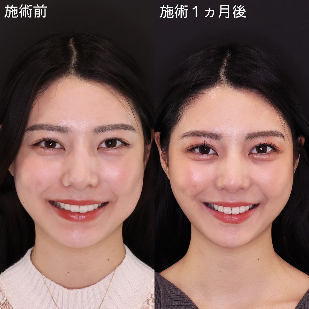 【2026最新】芸能人の糸リフト事情！公表タレントと若さの秘密