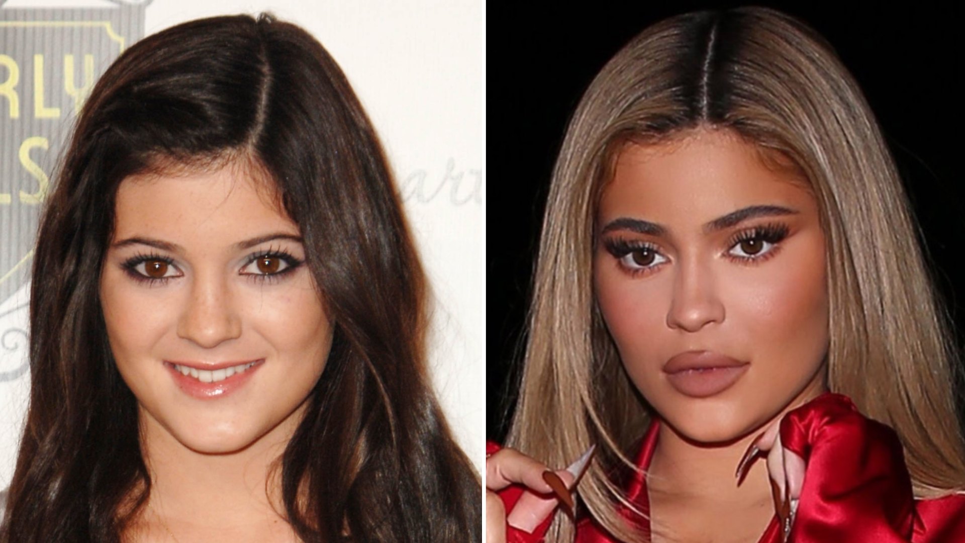 Kylie Jenner Before and After Plastic Surgery