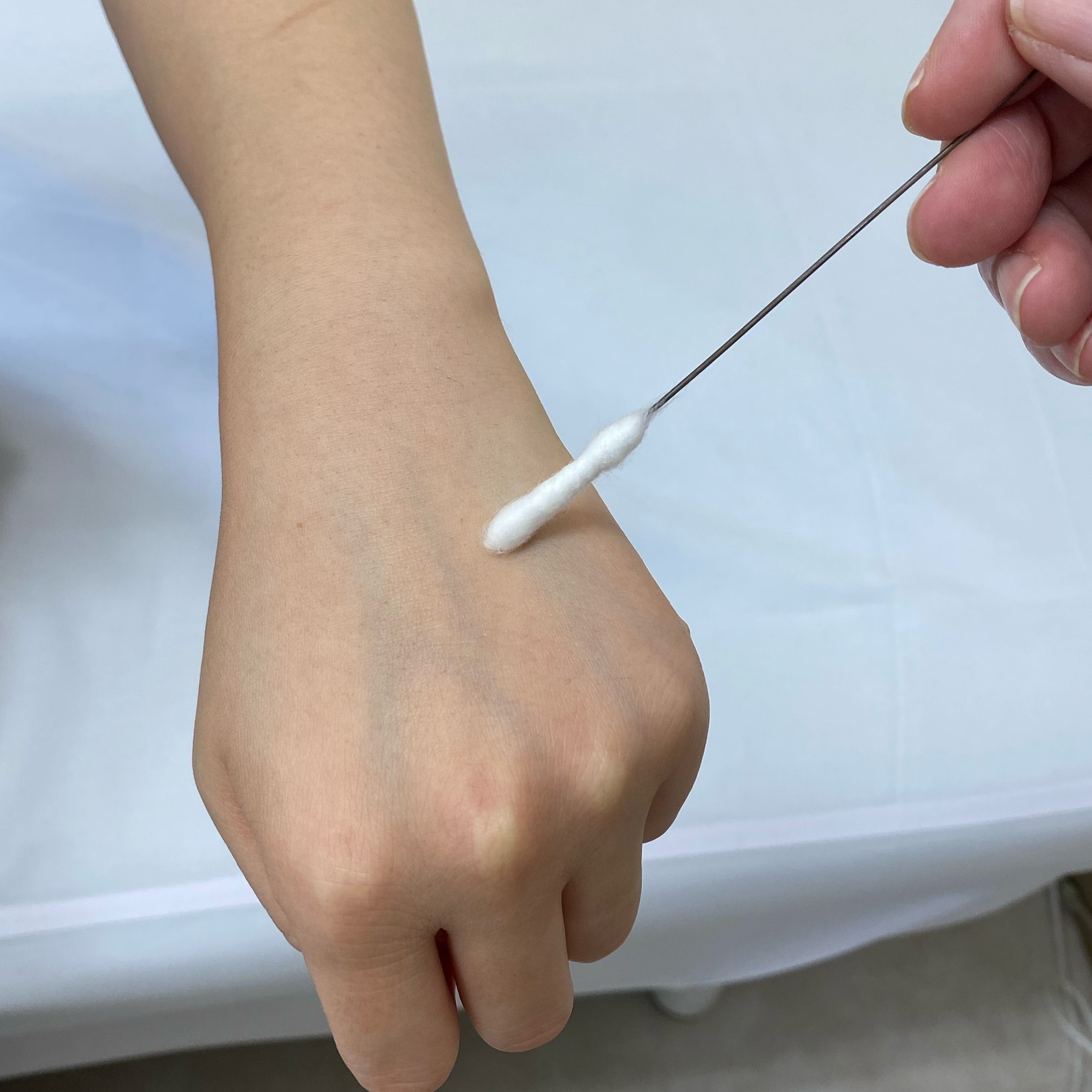 イボの液体窒素治療は激痛？完治までの回数と水ぶくれの対処法を徹底解説