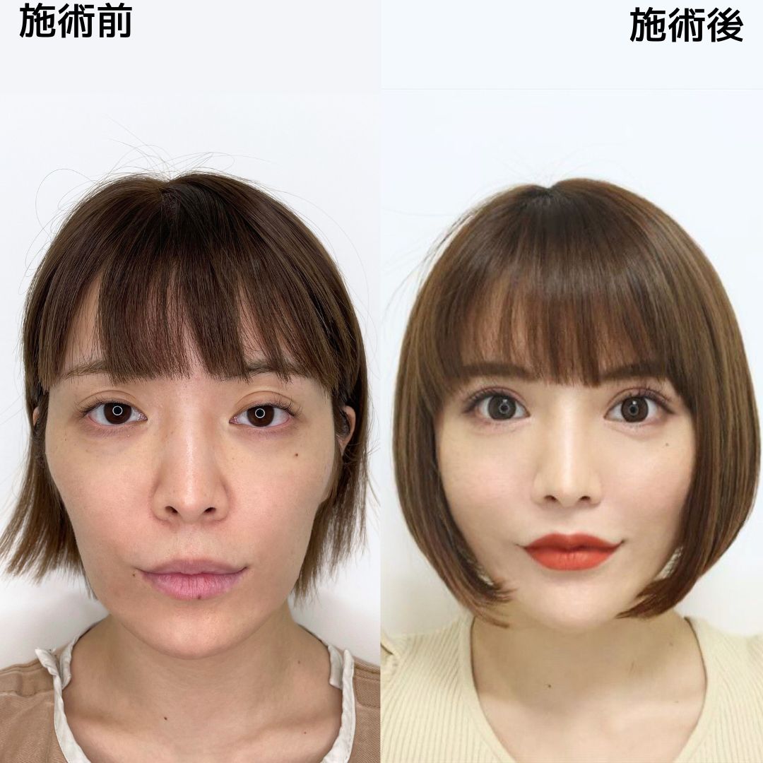 芸能人のほうれい線ヒアルロン酸注入の真相！失敗回避と名医選び