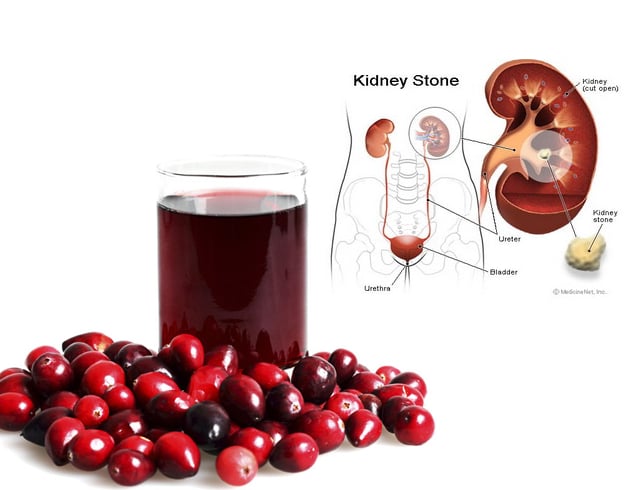 Cranberry Juice and Kidney Stones