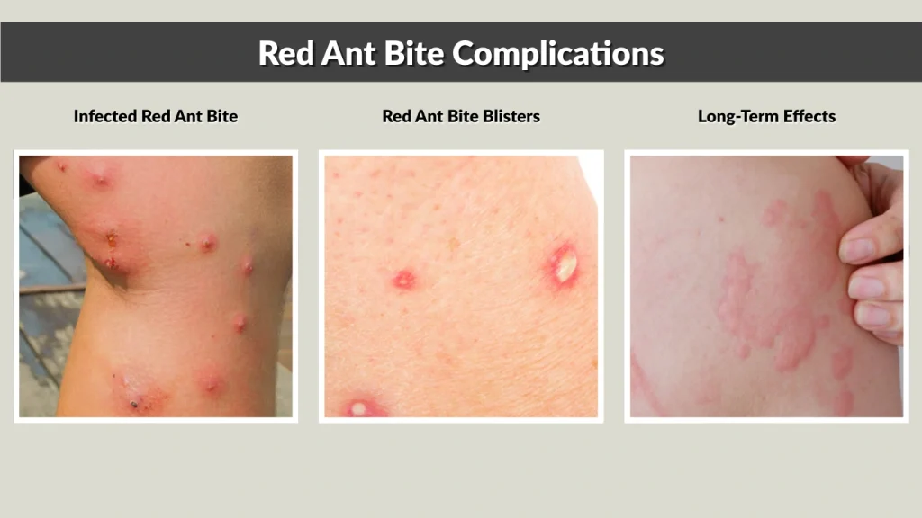 Ant Bites on Skin
