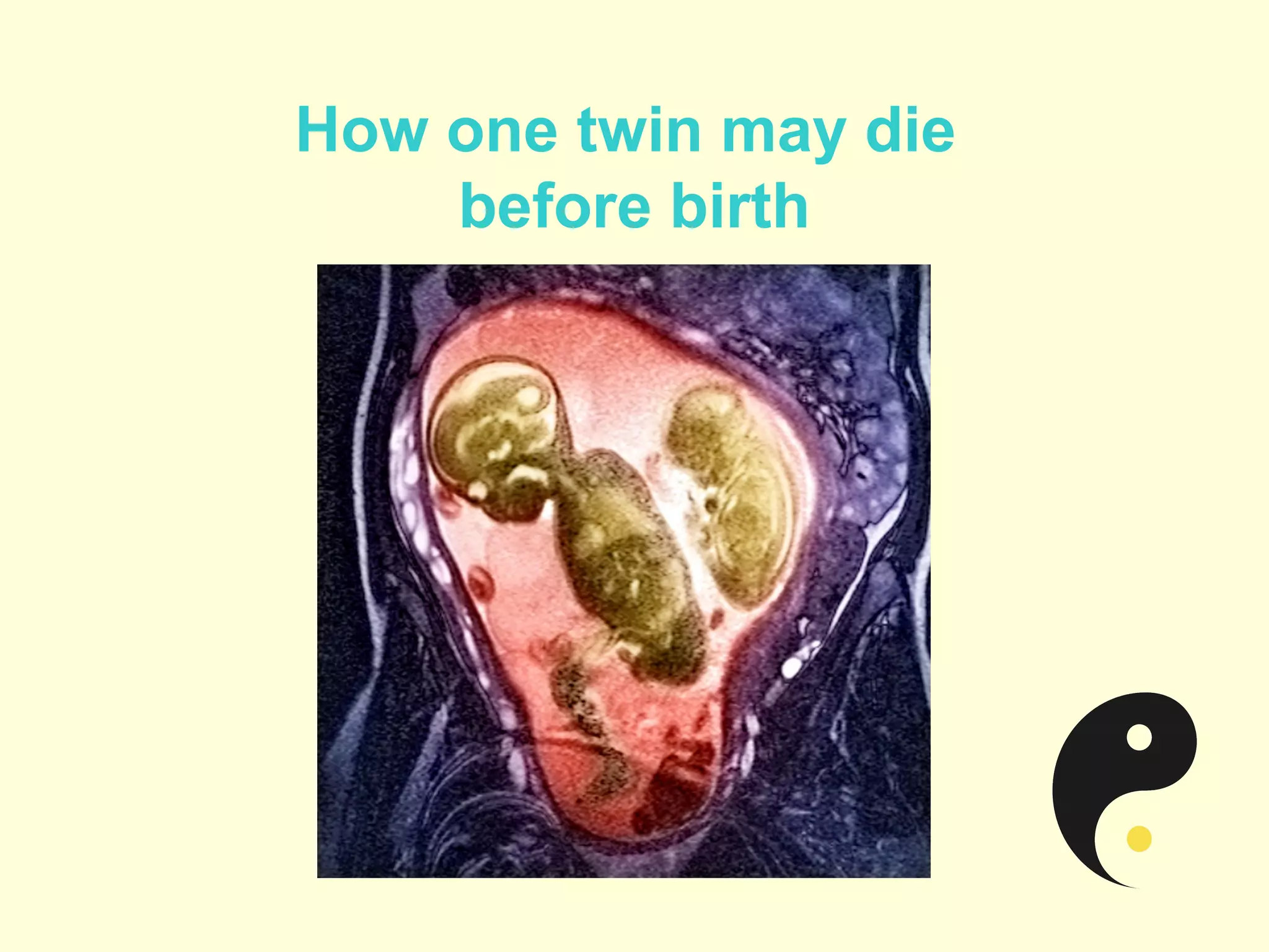 If One Twin Dies in the Womb What Happens